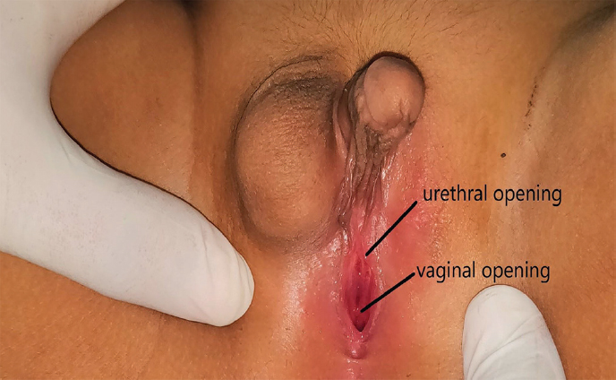 Phallus with right hemiscrotum with two opening - urethral opening (open arrows) and vaginal opening (solid arrows).